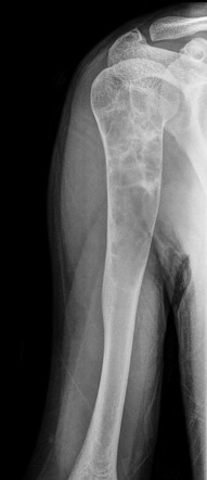 Cystic lesion of the proximal humerus | Radiology Case | Radiopaedia.org