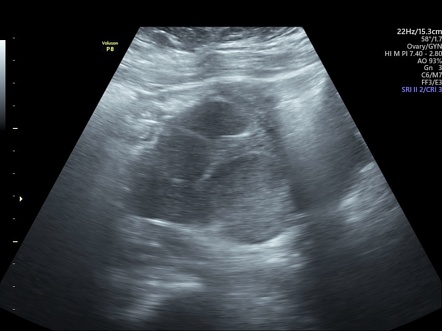 Hematosalpinx | Image | Radiopaedia.org