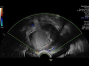 Hematosalpinx | Radiology Reference Article | Radiopaedia.org