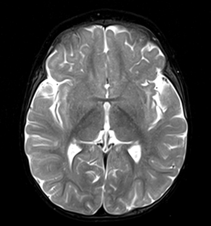 Infantile Hemangioma Of The Scalp 