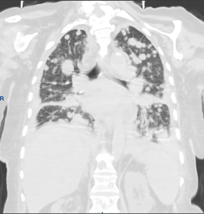 Advanced breast cancer with cannon ball pulmonary metastases ...