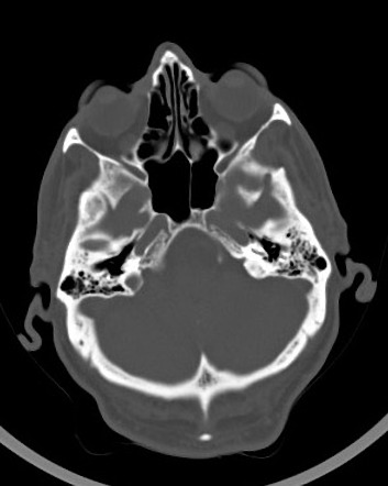 Trochlear apparatus calcification | Image | Radiopaedia.org