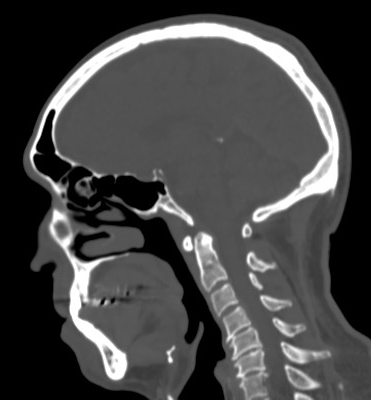 Trochlear apparatus calcification | Image | Radiopaedia.org