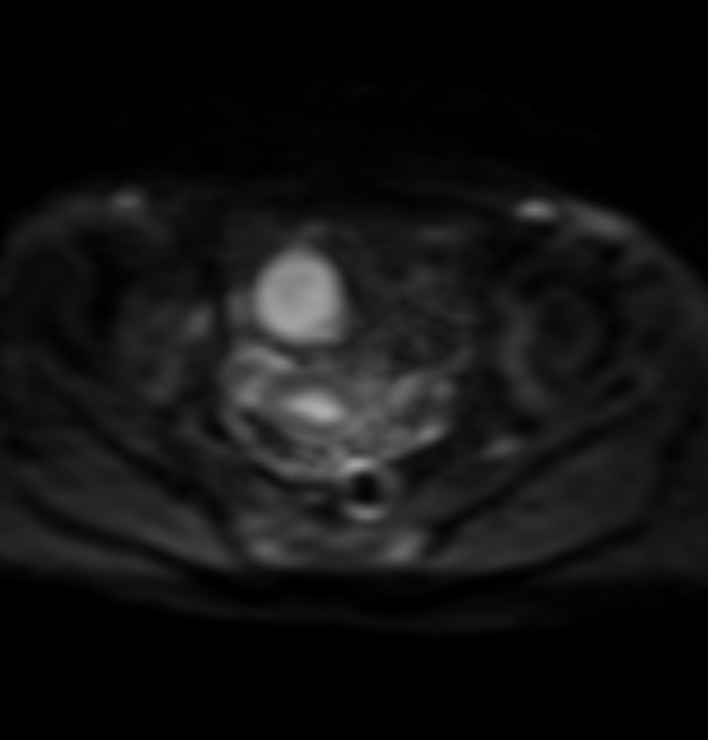 Ruptured Appendiceal Mucocele With Pseudomyxoma Peritonei Image