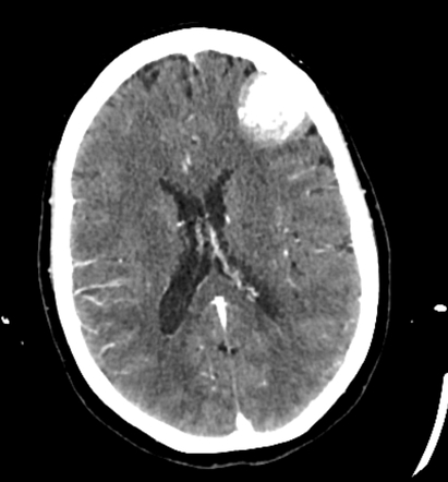 Meningioma - frontal | Radiology Case | Radiopaedia.org