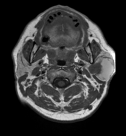 Parotid Gland Tumor Mri