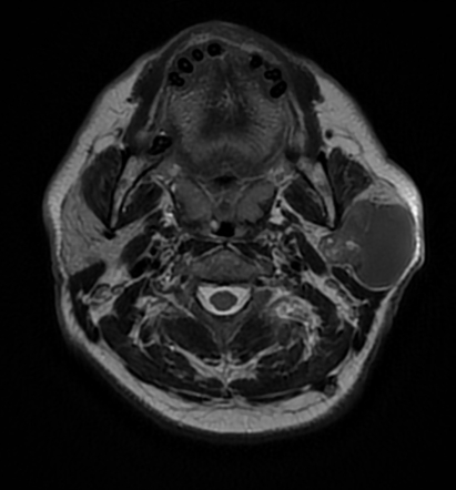 Warthin tumor - parotid gland | Image | Radiopaedia.org