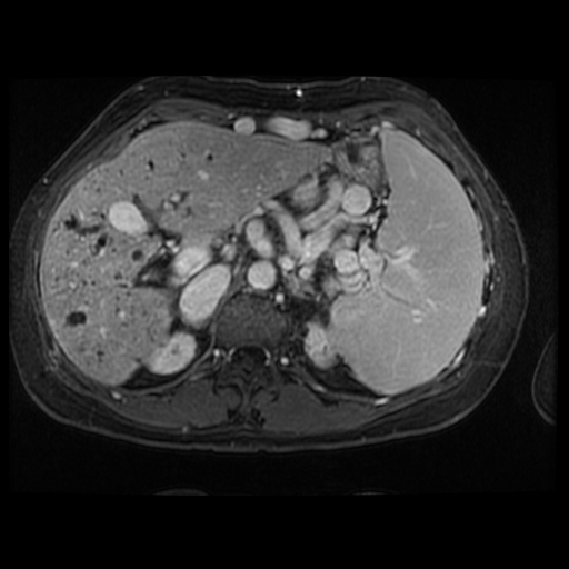 Caroli disease | Image | Radiopaedia.org