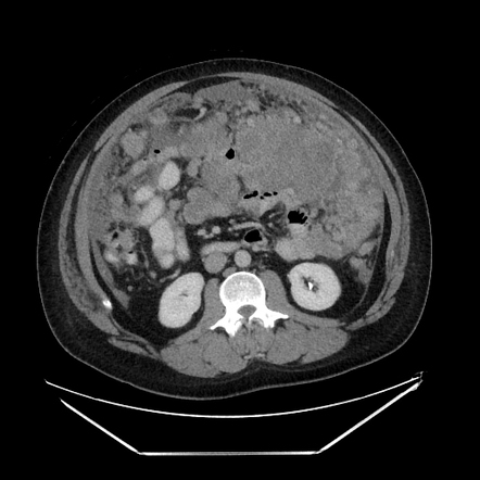 Desmoplastic Small Round Cell Tumor (peritoneal) 