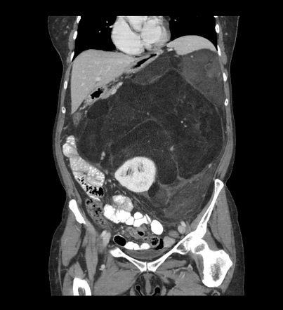 Retroperitoneal liposarcoma | Radiology Reference Article | Radiopaedia.org