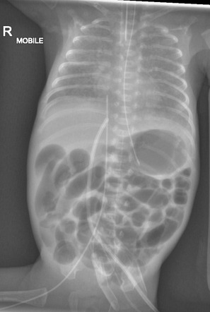 Neonatal lines and tubes | Radiology Case | Radiopaedia.org