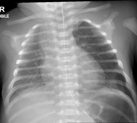 Neonatal pneumothorax | Radiology Case | Radiopaedia.org