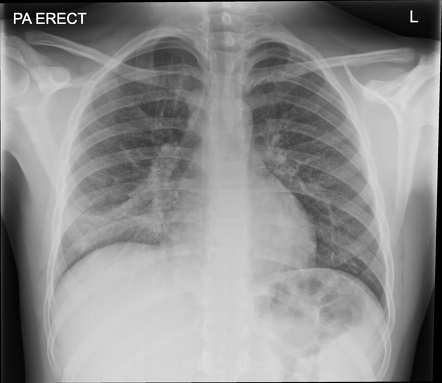 Right middle lobe pneumonia - adolescent | Radiology Case | Radiopaedia.org