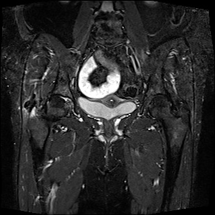 Intraosseous Extension Of Calcific Gluteus Medius Tendonitis