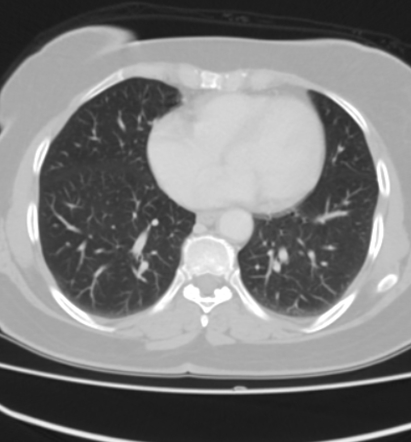 Ruptured appendiceal mucocele with pseudomyxoma peritonei | Image ...