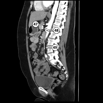 Renal vein | Radiology Reference Article | Radiopaedia.org