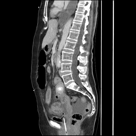 Gallstone ileus | Image | Radiopaedia.org