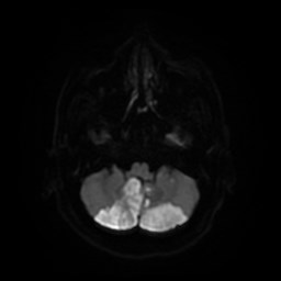 Bilateral cerebellar infarction | Image | Radiopaedia.org