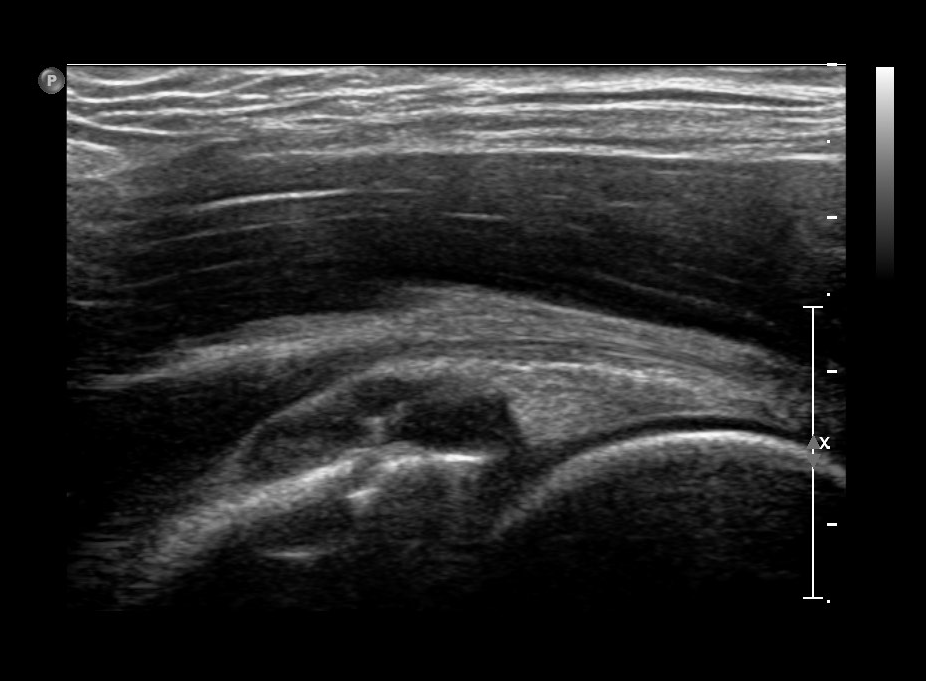 Paralabral cyst of the hip (US and MRI) | Image | Radiopaedia.org