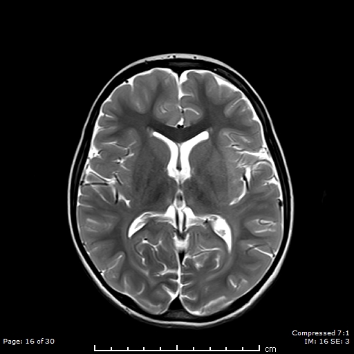 Neuronal Ceroid Lipofuscinosis Image