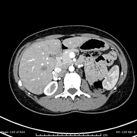 Crossed fused renal ectopia - type E | Image | Radiopaedia.org