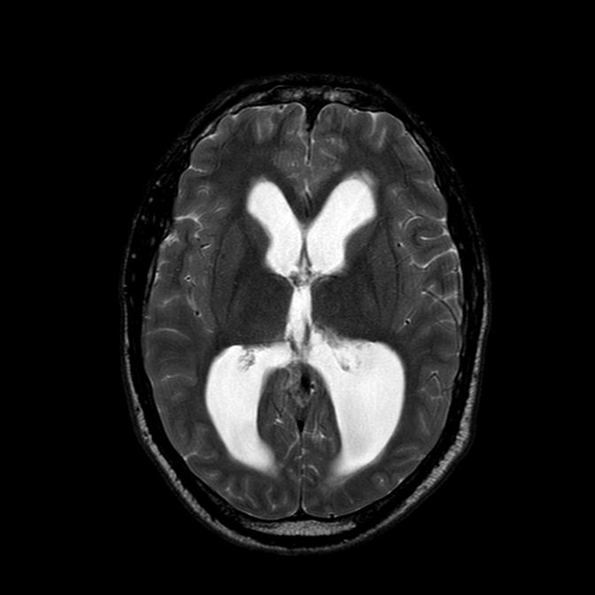 Neurofibromatosis Type 2 Image 3382