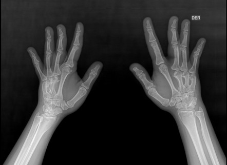 Brachydactyly | Radiology Case | Radiopaedia.org