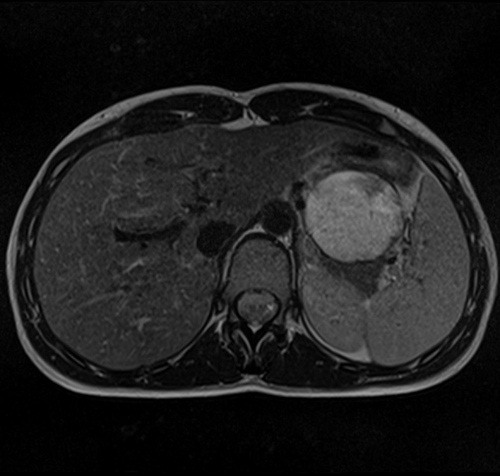 Solid Pseudopapillary Tumor Of The Pancreas Frantz Tumor Image