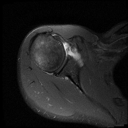 Hill-Sachs defect with bony Bankart lesion | Radiology Case ...