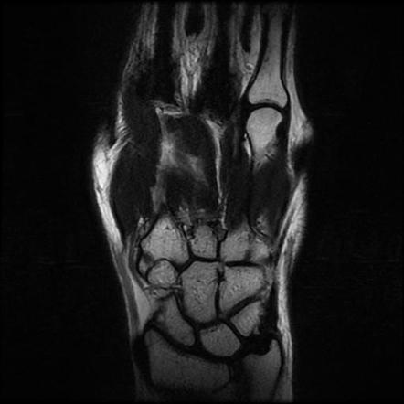 Carpal Boss Image Radiopaedia Org