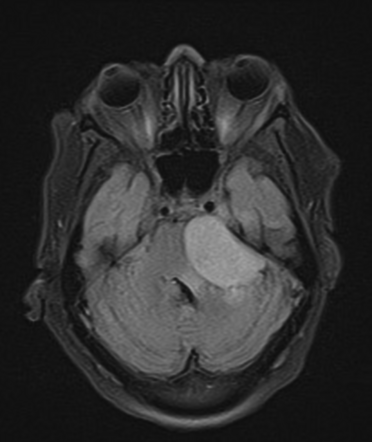 Large cerebellopontine angle meningioma with obstructive hydrocephalus ...