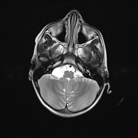 Arachnoid cyst - cerebellomedullary cistern | Radiology Case ...