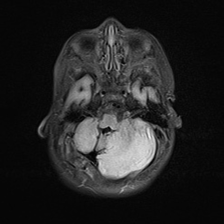 Cerebellar hypoplasia - unilateral | Image | Radiopaedia.org