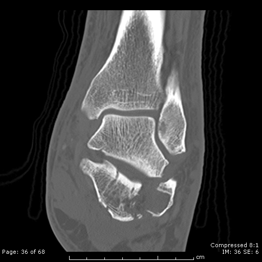 Calcaneal fracture - Sanders type 3bc | Image | Radiopaedia.org