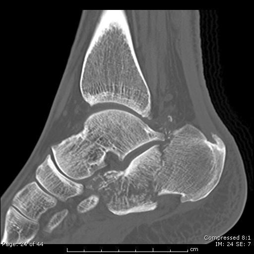 Calcaneal Fracture Sanders Type 3bc Image