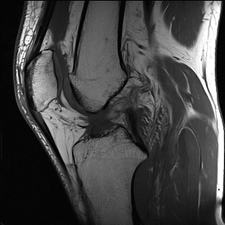 Anterior cruciate ligament complete tear | Image | Radiopaedia.org