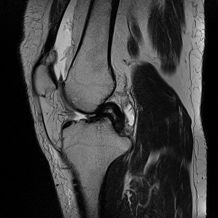 Anterior cruciate ligament tear and Bucket handle tear of medial ...