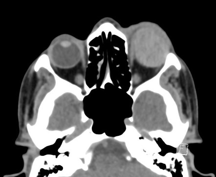 Radiology Quiz 93847 | Radiopaedia.org | Playlist 'EM exam 1' by Allie ...