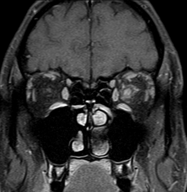 Optic neuritis with perineuritis | Image | Radiopaedia.org