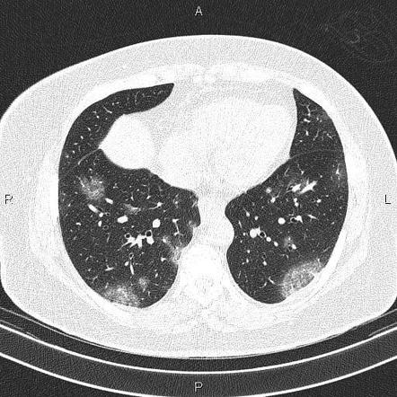 Reversed halo sign - COVID-19 | Radiology Case | Radiopaedia.org