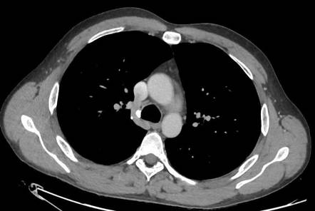 Azygos arch valve | Image | Radiopaedia.org