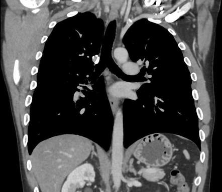 Azygos arch valve | Radiology Case | Radiopaedia.org