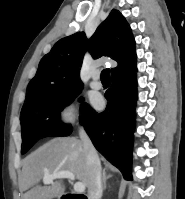 Azygos arch valve | Image | Radiopaedia.org