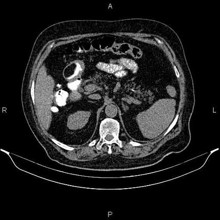 Gastric Lipoma Radiology Reference Article Radiopaedia Org