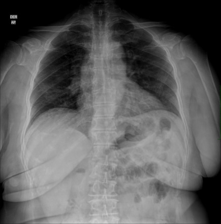 Butterfly vertebra | Image | Radiopaedia.org