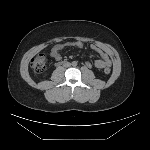 Tip appendicitis | Image | Radiopaedia.org