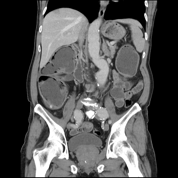 Malignant large bowel obstruction | Image | Radiopaedia.org