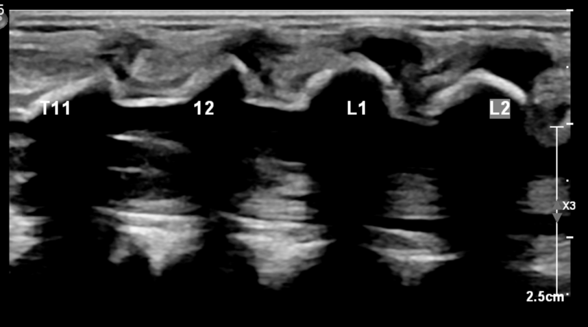 Pseudosinus tract | Image | Radiopaedia.org