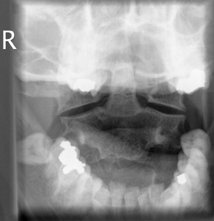 Congenital anomaly of the posterior arch of C1 - Currarino type D ...