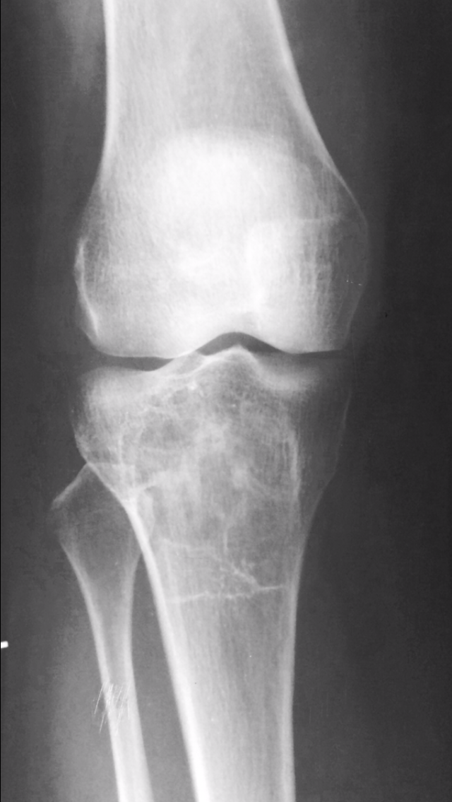 Giant Cell Tumor Proximal Tibia Image